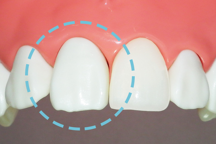 審美歯科診療-オールジルコニア