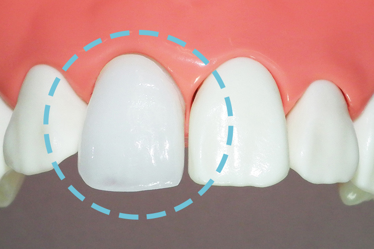 審美歯科診療-オールセラミック