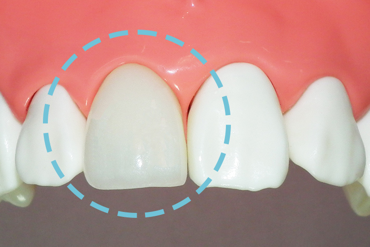 審美歯科診療-メタルボンド